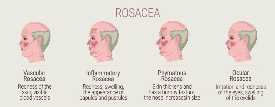 How Cannabis And Hemp Can Reduce Symptoms Of Rosacea - RQS Blog