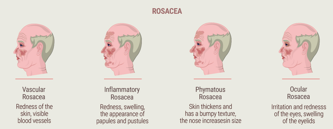 What Is Rosacea?