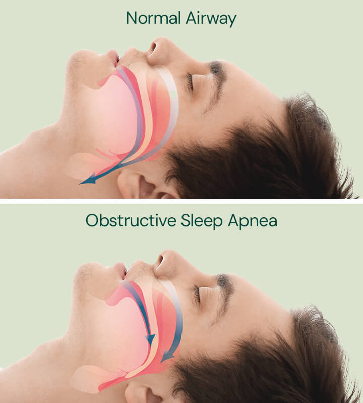 Sleep Apnea Cannabis